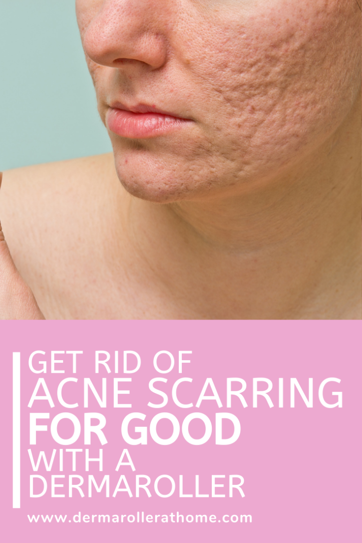 acne scarring dermaroller